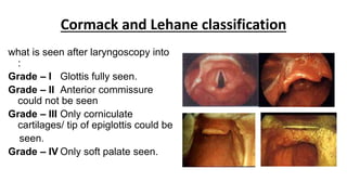 Cormack and Lehane classification
what is seen after laryngoscopy into
:
Grade – I Glottis fully seen.
Grade – II Anterior commissure
could not be seen
Grade – III Only corniculate
cartilages/ tip of epiglottis could be
seen.
Grade – IV Only soft palate seen.
 
