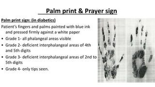 Palm print & Prayer sign
Palm print sign: (in diabetics)
Patient’s fingers and palms painted with blue ink
and pressed firmly against a white paper
• Grade 1- all phalangeal areas visible
• Grade 2- deficient interphalangeal areas of 4th
and 5th digits
• Grade 3- deficient interphalangeal areas of 2nd to
5th digits
• Grade 4- only tips seen.
 