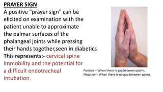 PRAYER SIGN
A positive "prayer sign" can be
elicited on examination with the
patient unable to approximate
the palmar surfaces of the
phalangeal joints while pressing
their hands together,seen in diabetics
This represents:- cervical spine
immobility and the potential for
a difficult endotracheal
intubation.
Positive – When there is gap between palms.
Negative – When there is no gap between palms
 