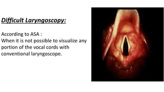 Difficult Laryngoscopy:
According to ASA :
When it is not possible to visualize any
portion of the vocal cords with
conventional laryngoscope.
 