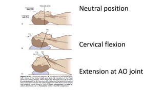 Neutral position
Cervical flexion
Extension at AO joint
 