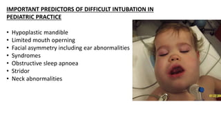 IMPORTANT PREDICTORS OF DIFFICULT INTUBATION IN
PEDIATRIC PRACTICE
• Hypoplastic mandible
• Limited mouth operning
• Facial asymmetry including ear abnormalities
• Syndromes
• Obstructive sleep apnoea
• Stridor
• Neck abnormalities
 