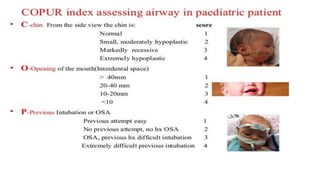 Airway assesment IN ANESTHESIA 