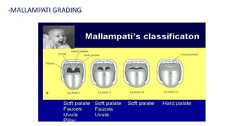 -MALLAMPATI GRADING
 