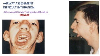 -Why would this Man’s airway be difficult to
MANAGE
-AIRWAY ASSESSMENT
DIFFICULT INTUBATION
 