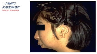 -AIRWAY
ASSESSMENT
DIFFICULT INTUBATION
 