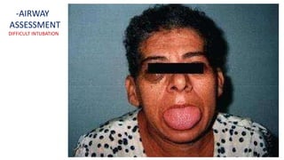 -AIRWAY
ASSESSMENT
DIFFICULT INTUBATION
 