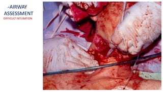 --AIRWAY
ASSESSMENT
DIFFICULT INTUBATION
 