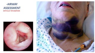 -AIRWAY
ASSESSMENT
DIFFICULT INTUBATION
 