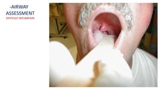 -AIRWAY
ASSESSMENT
DIFFICULT INTUBATION
 