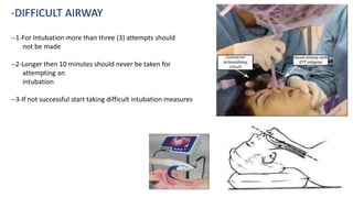 --1-For Intubation more than three (3) attempts should
not be made
--2-Longer then 10 minutes should never be taken for
attempting an
intubation
--3-If not successful start taking difficult intubation measures
-DIFFICULT AIRWAY
 