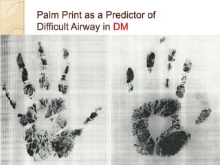 Palm Print as a Predictor of
Difficult Airway in DM
 