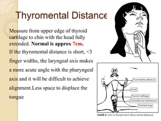 Thyromental Distance