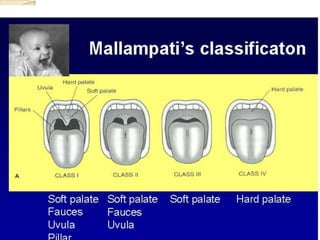 SIGNIFICANCE OF MMP SCORE
   Class III or IV: signifies that the angle between
    the base of tongue and laryngeal inlet...