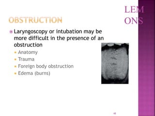 48
 Laryngoscopy or intubation may be
more difficult in the presence of an
obstruction
 Anatomy
 Trauma
 Foreign body obstruction
 Edema (burns)
LEM
ONS
 