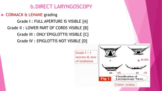b.DIRECT LARYNGOSCOPY
 CORMACK & LEHANE grading
Grade I : FULL APERTURE IS VISIBLE [A]
Grade II : LOWER PART OF CORDS VISIBLE [B]
Grade III : ONLY EPIGLOTTIS VISIBLE [C]
Grade IV : EPIGLOTTIS NOT VISIBLE [D]
 