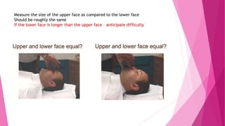 Measure the size of the upper face as compared to the lower face
Should be roughly the same
If the lower face is longer than the upper face – anticipate difficulty
 