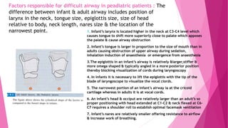 Factors responsible for difficult airway in peadiatric patients : The
difference between infant & adult airway includes position of
larynx in the neck, tongue size, epiglottis size, size of head
relative to body, neck length, nares size & the location of the
narrowest point. 1. Infant’s larynx is located higher in the neck at C3-C4 level which
causes tongue to shift more superiorly close to palate which apposes
the palate & cause airway obstruction
2. Infant’s tongue is larger in proportion to the size of mouth than in
adults causing obstruction of upper airway during sedation,
inhalation induction of anaesthesia or emergence from anaesthesia
3.The epiglottis in an infant’s airway is relatively &larger,stiffer &
more omega shaped & typically angled in a more posterior position
thereby blocking visualization of cords during laryngoscopy
4. In infants it is necessary to lift the epiglottis with the tip of the
blade of laryngoscope to visualize the vocal ciords.
5. The narrowest portion of an infant’s airway ia at the cricoid
cartilage whereas in adults it is at vocal cords.
6. An infant’s head & occiput are relatively larger than an adult’s so
proper positioning with head extended at C1-C2 & neck flexed at C6-
C7 requires a shoulder roll to establish optimal facemask ventilation
7. Infant’s nares are relatively smaller offering resistance to airflow
& increase work of breathing.
 