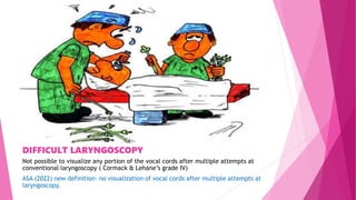 DIFFICULT LARYNGOSCOPY
Not possible to visualize any portion of the vocal cords after multiple attempts at
conventional laryngoscopy ( Cormack & Lehane’s grade IV)
ASA (2022) new definition- no visualization of vocal cords after multiple attempts at
laryngoscopy.
 