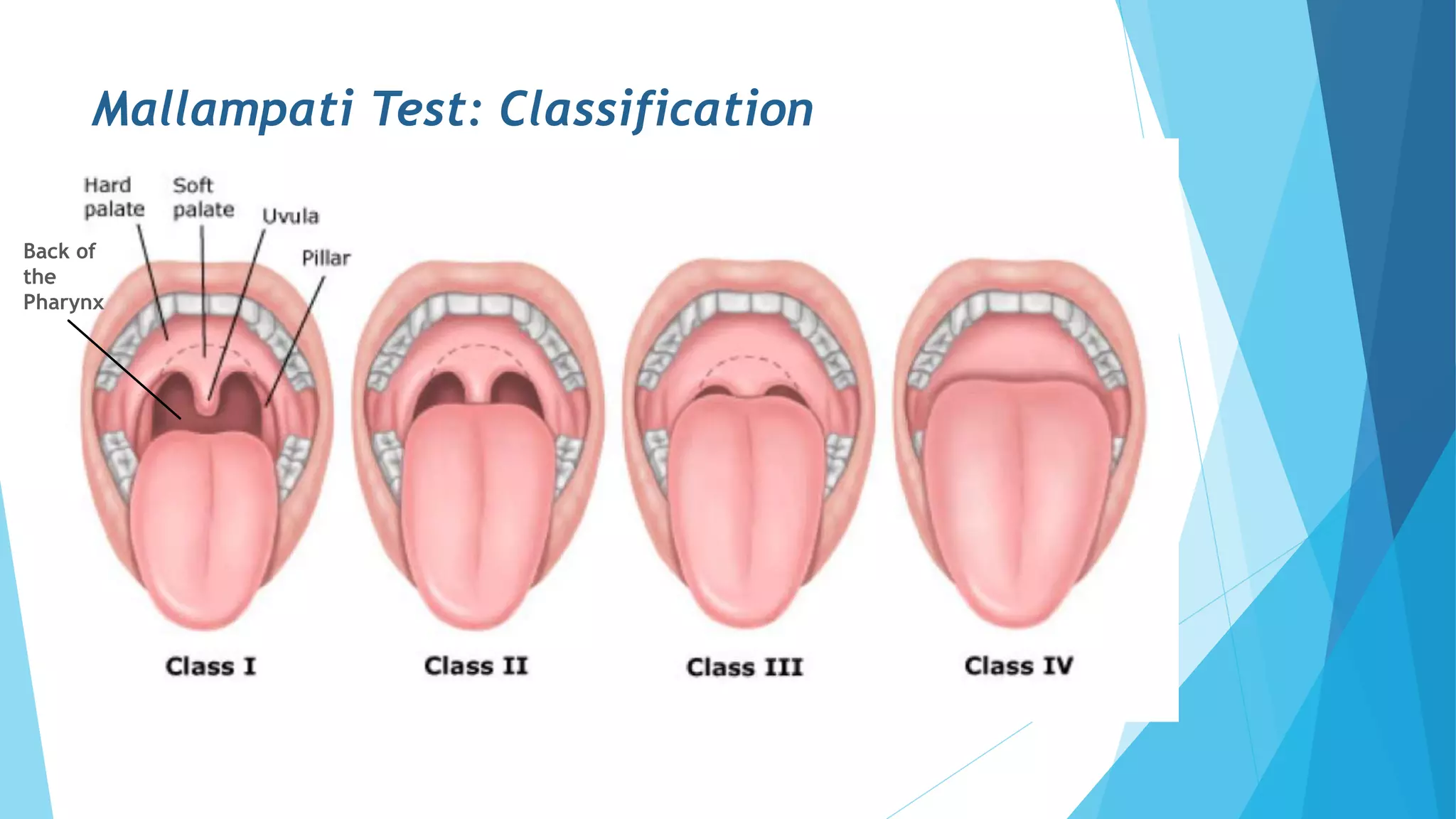 airway-assessment-in-anaesthesia-pptx