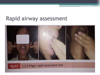 Rapid airway assessment
 