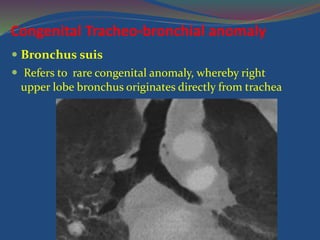 Congenital Tracheo-bronchial anomaly
 Bronchus suis
 Refers to rare congenital anomaly, whereby right
upper lobe bronchus originates directly from trachea
 