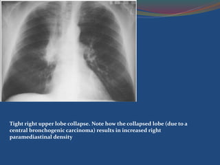 Tight right upper lobe collapse. Note how the collapsed lobe (due to a
central bronchogenic carcinoma) results in increased right
paramediastinal density
 