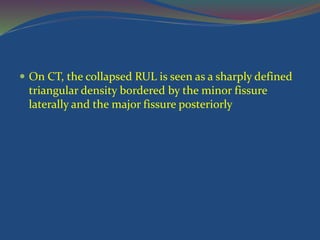  On CT, the collapsed RUL is seen as a sharply defined
triangular density bordered by the minor fissure
laterally and the major fissure posteriorly
 