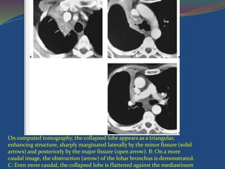 On computed tomography, the collapsed lobe appears as a triangular,
enhancing structure, sharply marginated laterally by the minor fissure (solid
arrows) and posteriorly by the major fissure (open arrow). B: On a more
caudal image, the obstruction (arrow) of the lobar bronchus is demonstrated.
C: Even more caudal, the collapsed lobe is flattened against the mediastinum
 