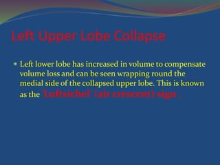Left Upper Lobe Collapse
 Left lower lobe has increased in volume to compensate
volume loss and can be seen wrapping round the
medial side of the collapsed upper lobe. This is known
as the 'Luftsichel' (air crescent) sign .
 