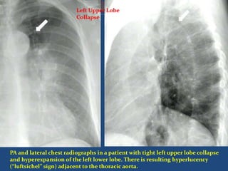PA and lateral chest radiographs in a patient with tight left upper lobe collapse
and hyperexpansion of the left lower lobe. There is resulting hyperlucency
(“luftsichel” sign) adjacent to the thoracic aorta.
Left Upper Lobe
Collapse
 