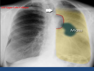 Left Upper Lobe Collapse
 