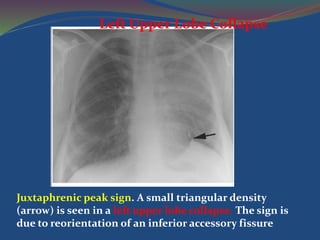 Juxtaphrenic peak sign. A small triangular density
(arrow) is seen in a left upper lobe collapse. The sign is
due to reorientation of an inferior accessory fissure
Left Upper Lobe Collapse
 