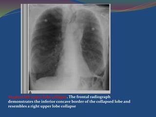 Atypical left upper lobe collapse. The frontal radiograph
demonstrates the inferior concave border of the collapsed lobe and
resembles a right upper lobe collapse
 