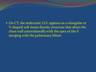  On CT, the atelectatic LUL appears as a triangular or
V-shaped soft tissue density structure that abuts the
chest wall anterolaterally with the apex of the V
merging with the pulmonary hilum
 