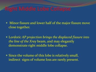 Right Middle Lobe Collapse
 Minor fissure and lower half of the major fissure move
close together.
 Lordotic AP projection brings the displaced fissure into
the line of the Xray beam, and may elegantly
demonstrate right middle lobe collapse.
 Since the volume of this lobe is relatively small,
indirect signs of volume loss are rarely present.
 