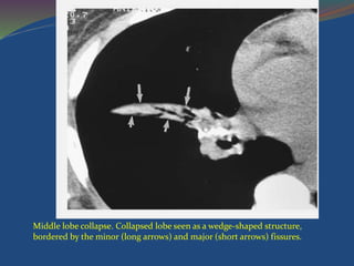 Middle lobe collapse. Collapsed lobe seen as a wedge-shaped structure,
bordered by the minor (long arrows) and major (short arrows) fissures.
 
