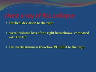 chest x-ray of RLL collapse
 Tracheal deviation to the right
 overall volume loss of the right hemithorax, compared
with the left.
 The mediastinum is therefore PULLED to the right.
 
