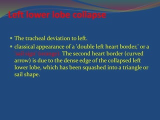 Left lower lobe collapse
 The tracheal deviation to left.
 classical appearance of a 'double left heart border,' or a
'sail sign' (orange). The second heart border (curved
arrow) is due to the dense edge of the collapsed left
lower lobe, which has been squashed into a triangle or
sail shape.
 