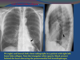 PA (right) and lateral (left) chest radiographs in a patient with tight left
lower lobe collapse. Note the triangular white opacity (black arrows)
behind the heart obscuring the posteromedial left hemidiaphragm.
Left lower lobe collapse.
 