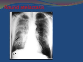 Round atelactasis
 
