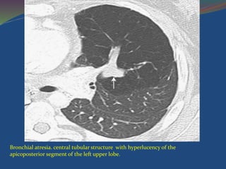 Bronchial atresia. central tubular structure with hyperlucency of the
apicoposterior segment of the left upper lobe.
 