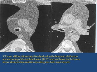 CT scan: diffuse thickening of tracheal wall with abnormal calcification
and narrowing of the tracheal lumen. (B) CT scan just below level of canna
shows identical abnormalities extending into both main bronchi.
 