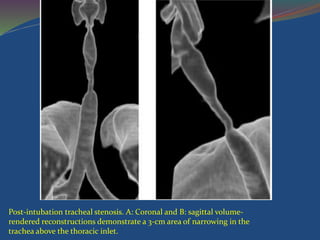 Post-intubation tracheal stenosis. A: Coronal and B: sagittal volume-
rendered reconstructions demonstrate a 3-cm area of narrowing in the
trachea above the thoracic inlet.
 