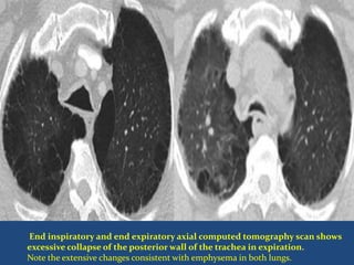 End inspiratory and end expiratory axial computed tomography scan shows
excessive collapse of the posterior wall of the trachea in expiration.
Note the extensive changes consistent with emphysema in both lungs.
 