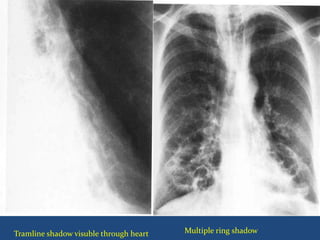  X ray photo
Multiple ring shadowTramline shadow visuble through heart
 