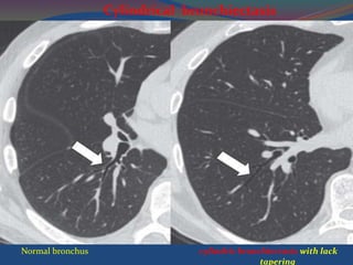 Normal bronchus cylindric bronchiectasis with lack
tapering
Cylindrical bronchiectasis
 