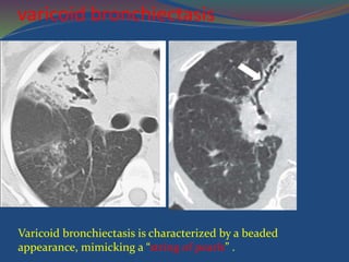 varicoid bronchiectasis
Varicoid bronchiectasis is characterized by a beaded
appearance, mimicking a “string of pearls” .
 