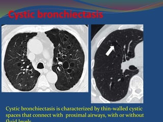 Cystic bronchiectasis
Cystic bronchiectasis is characterized by thin-walled cystic
spaces that connect with proximal airways, with or without
 