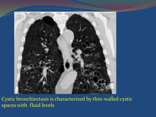 Cystic bronchiectasis is characterized by thin-walled cystic
spaces with fluid levels
 
